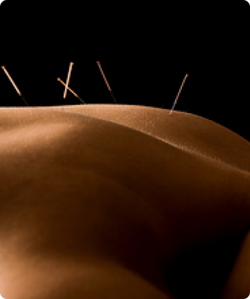 Acupuncture Body Sculpting